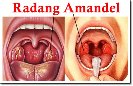 obat amandel k-link - Radang tonsil dari produk k-link obat amandel k-link - Radang tonsil dari produk k-link