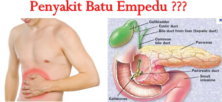 Gejala & Solusi Masalah Batu Empedu Gejala & Solusi Masalah Batu Empedu