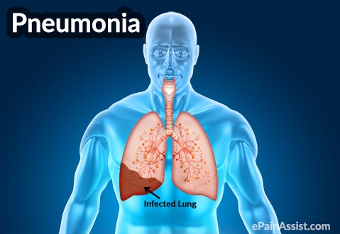 Obat pneumonia - Pengobatan herbal penyakit pneumonia Obat pneumonia - Pengobatan herbal penyakit pneumonia