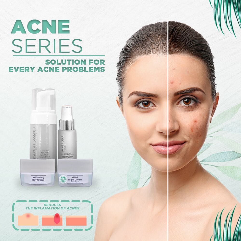 Cara Pemakaian Ms Glow Acne Series (Tips Agar Hasil Maksimal) Cara Pemakaian Ms Glow Acne Series (Tips Agar Hasil Maksimal)