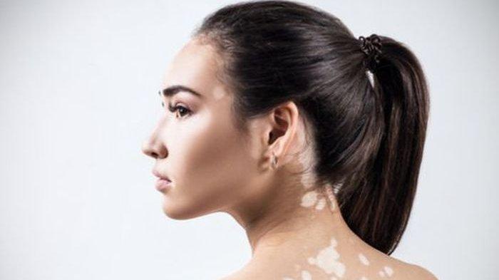 Vitiligo - Obat Pengobatan Penyembuahn Vitiligo dengan Produk k-link Vitiligo - Obat Pengobatan Penyembuahn Vitiligo dengan Produk k-link