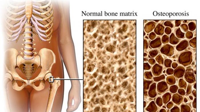 Produk K-Link Untuk Penyakit Osteoporosis atau Rapuh Tulang Produk K-Link Untuk Penyakit Osteoporosis atau Rapuh Tulang