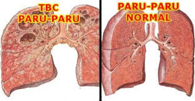 Obat Herbal Produk K-link untuk Tuberkulosa TBC atau penyakit paru paru Obat Herbal Produk K-link untuk Tuberkulosa TBC atau penyakit paru paru