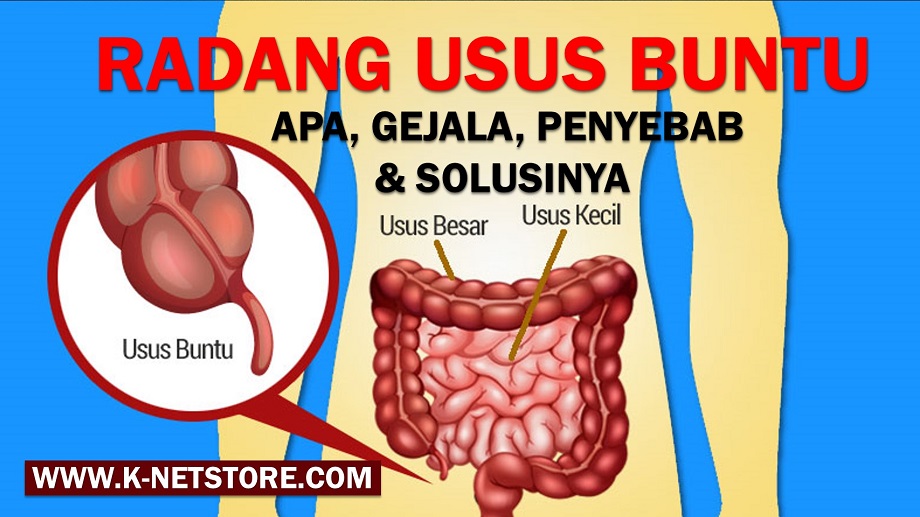 Appendicitis (Radang Usus Buntu) Appendicitis (Radang Usus Buntu)