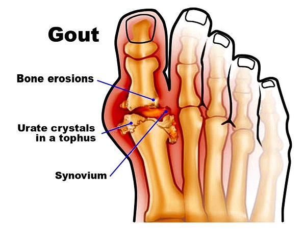Gejala Penyebab Pencegahan Artritis Nyeri Sendi Osteoartritis Gejala Penyebab Pencegahan Artritis Nyeri Sendi Osteoartritis