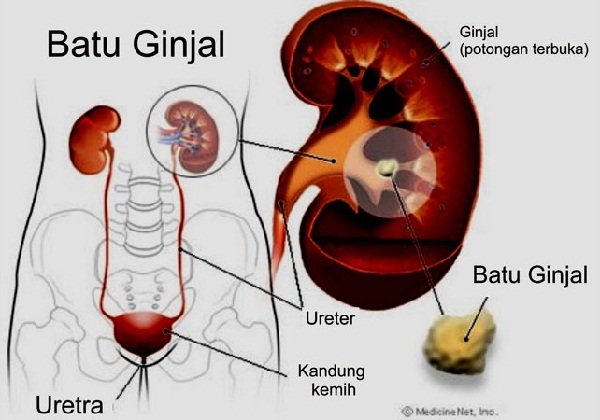 Gangguan Saluran Kemih dan Batu Ginjal Gangguan Saluran Kemih dan Batu Ginjal