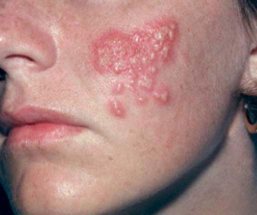 Produk K-Link Penyakit Herpes Pada Alat kelamin Pria Wanita Produk K-Link Penyakit Herpes Pada Alat kelamin Pria Wanita