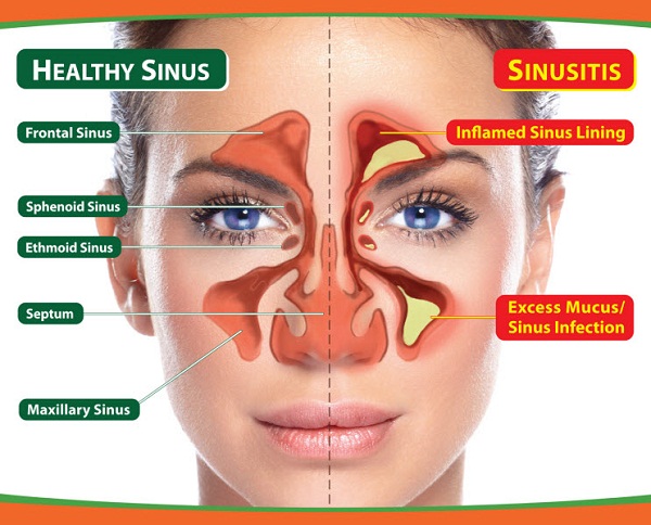 Sinusitis - Obat Produk k-link untuk penyakit sinusitis Sinusitis - Obat Produk k-link untuk penyakit sinusitis