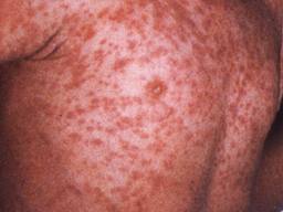 Apa, Gejala & Solusi Campak ( Rubella ) Apa, Gejala & Solusi Campak ( Rubella )