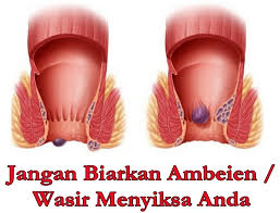 Obat Solusi wasir ambeian produk k-link Obat Solusi wasir ambeian produk k-link