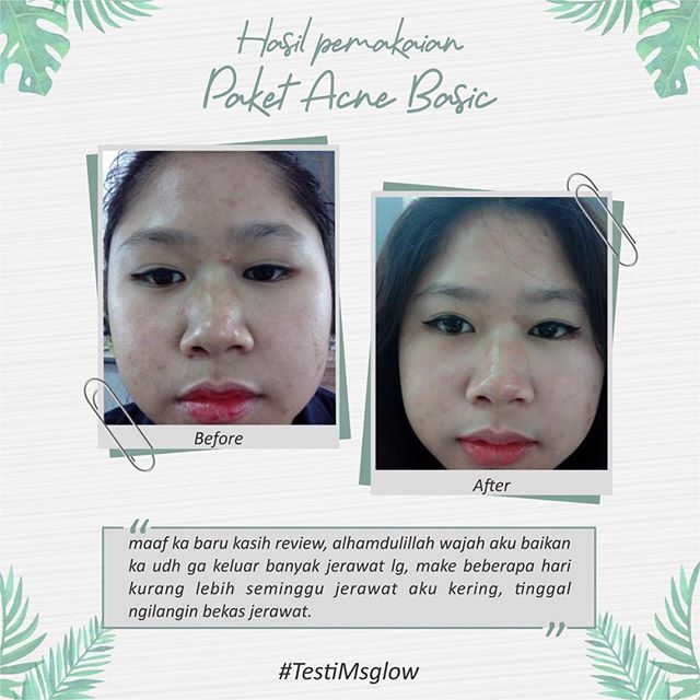 Skincare Untuk Kulit Berjerawat: MS Glow Solusinya ! Skincare Untuk Kulit Berjerawat: MS Glow Solusinya !